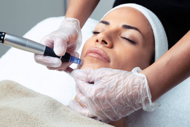Potenza_Microneedling_tpng-800x533.jpg